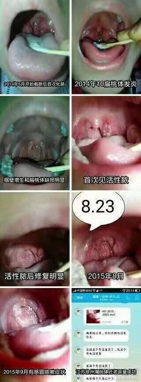 化脓性扁桃体炎多久(化脓性扁桃体炎多久才能痊愈)